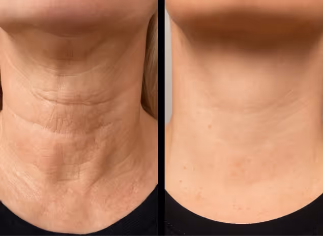 Before and after images showing improved skin texture and firmness from Natural Beauty by Helen's facial treatments in Twickenham.