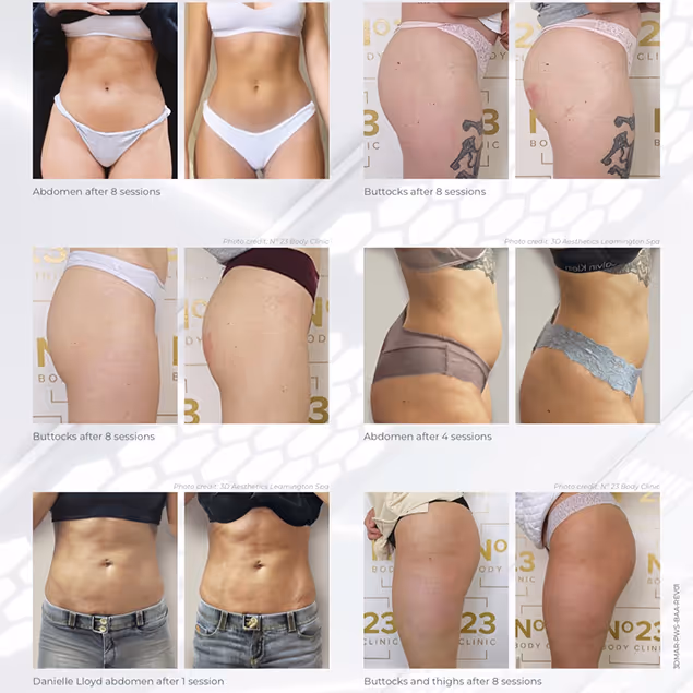 Before and after results of body sculpting treatments at Natural Beauty by Helen, showcasing enhanced abdomen and buttocks.