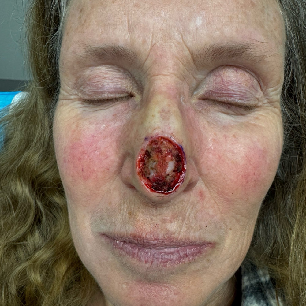 Paramedian Forehead Flap Before