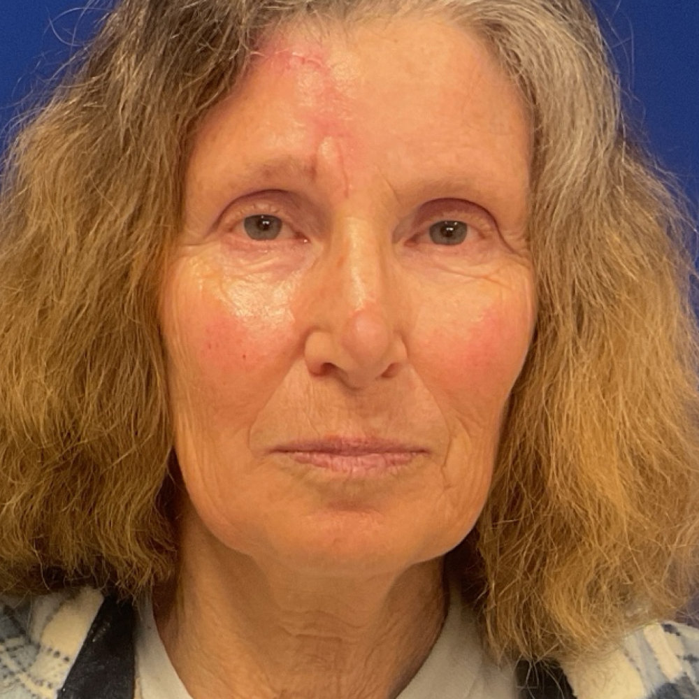 Paramedian Forehead Flap After