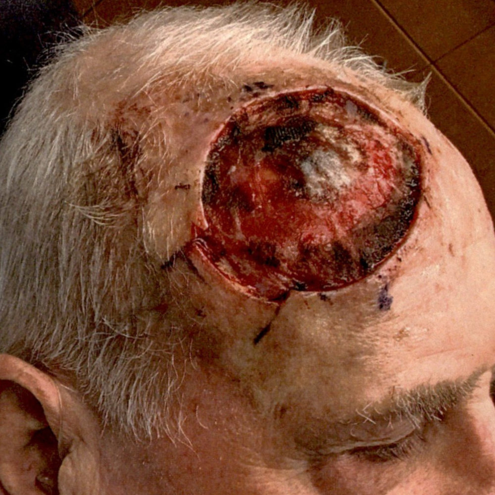 Skin Cancer Excision and Skin Graft Before