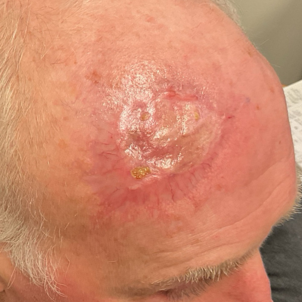 Skin Cancer Excision and Skin Graft After