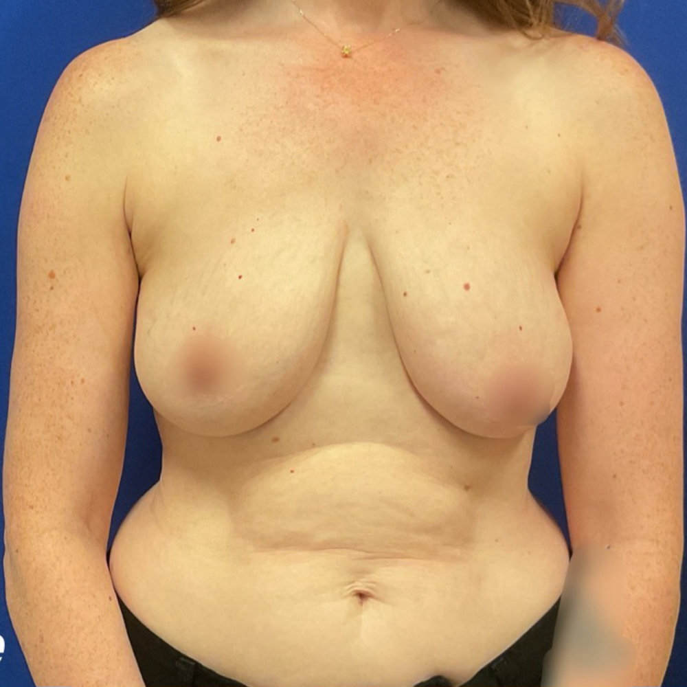 Before mommy makeover procedure with dr. iyengar