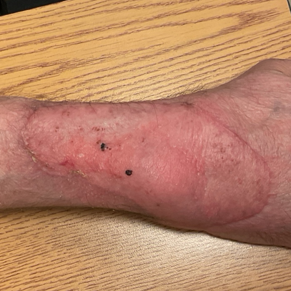 Arm Skin Graft After