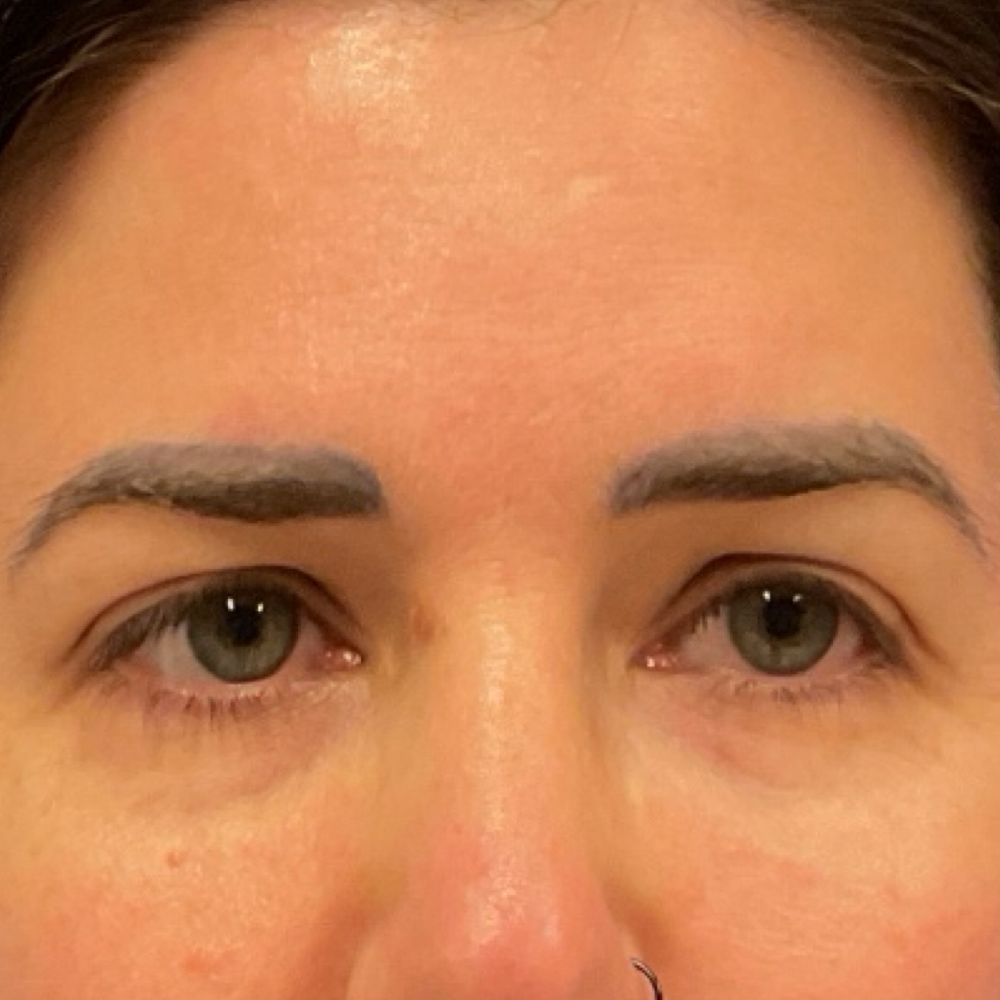 Browlift, Upper Blepharoplasty, Nanofat Transfer, and Neck Liposuction with Renuvion Before