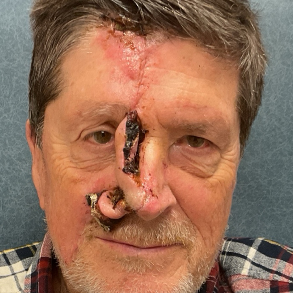 Forehead and nasolabial flap for skin cancer before