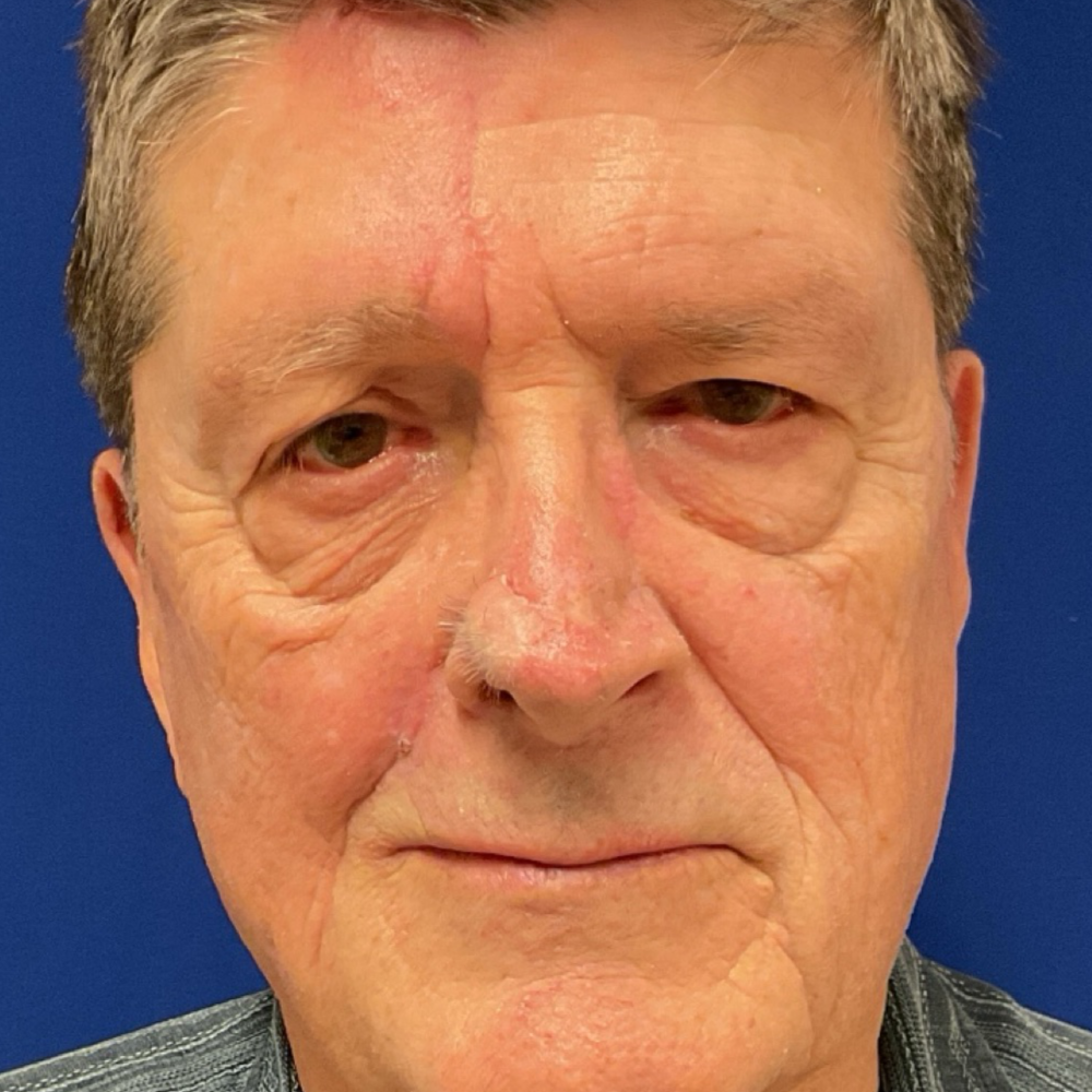 Forehead and nasolabial flap for skin cancer after