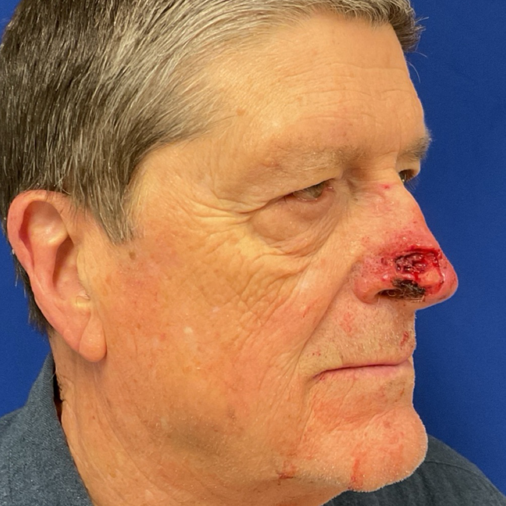 Forehead and nasolabial flap for skin cancer before
