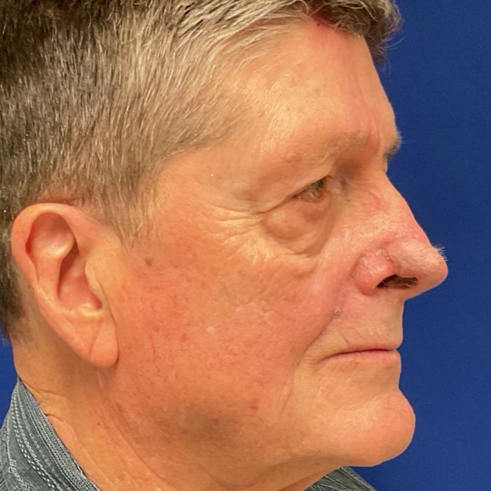 Forehead and nasolabial flap for skin cancer after
