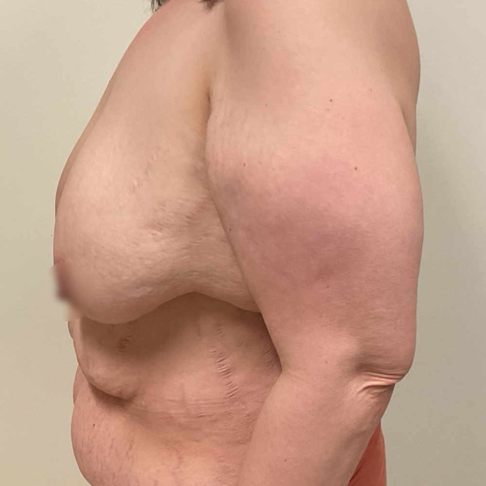 Breast Reduction Before