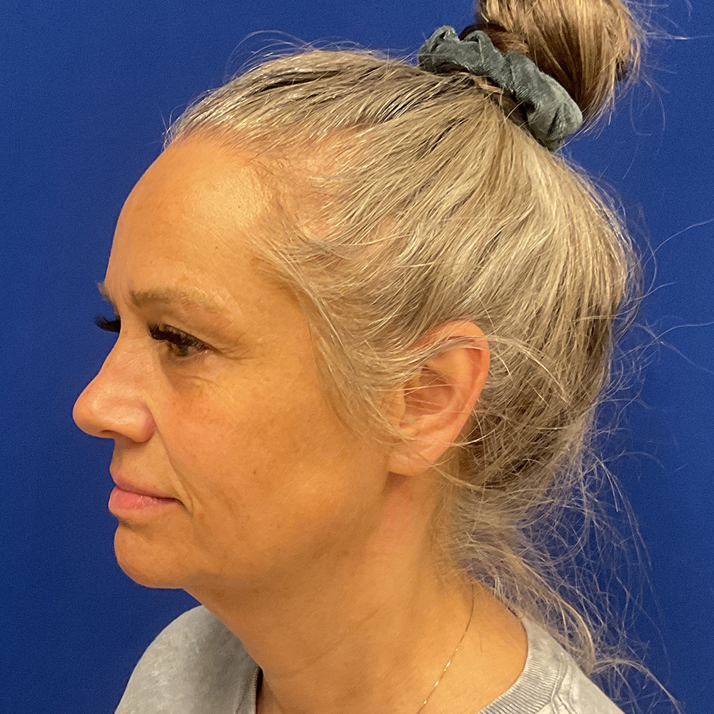 Facelift and necklift before the surgery