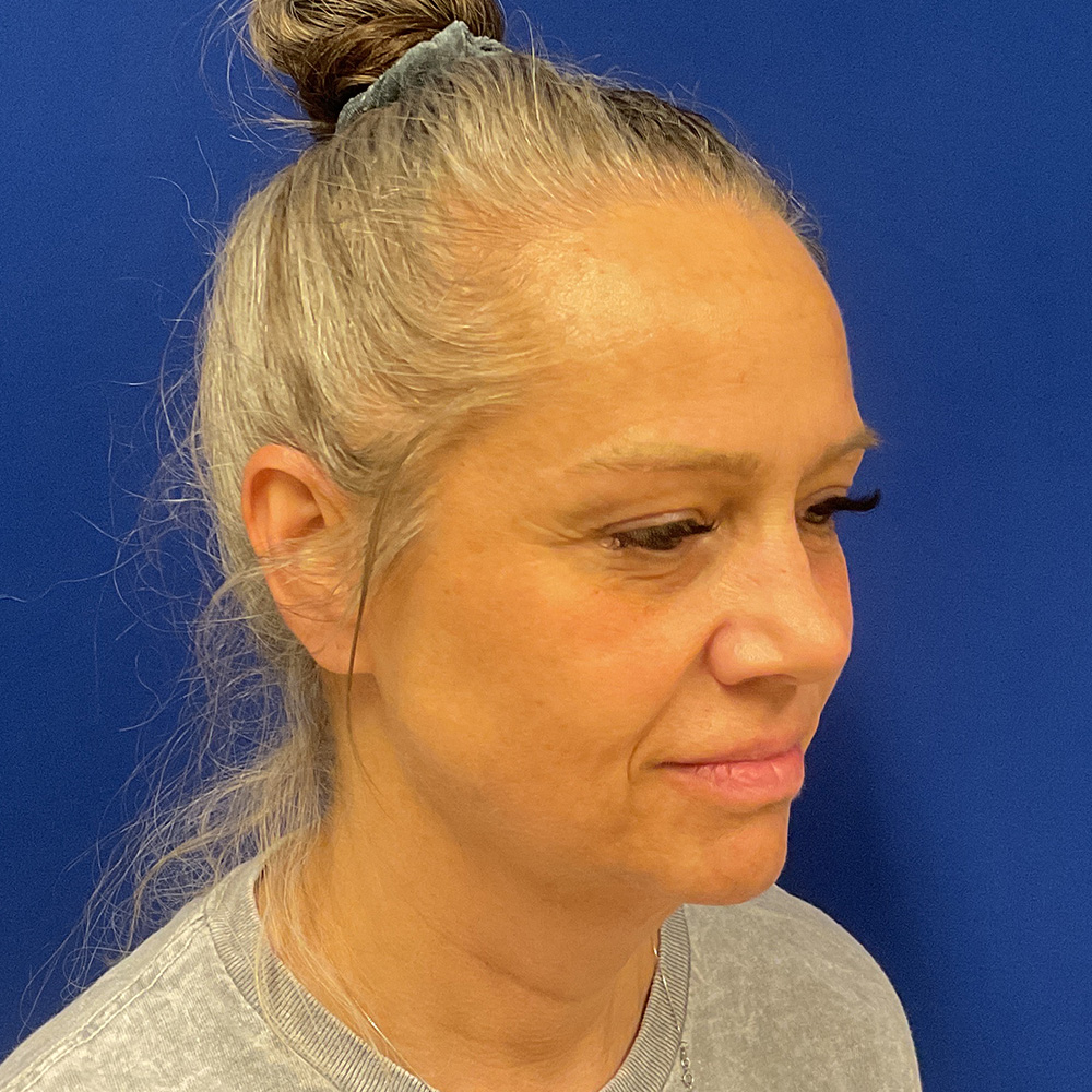 Facelift and necklift before the surgery