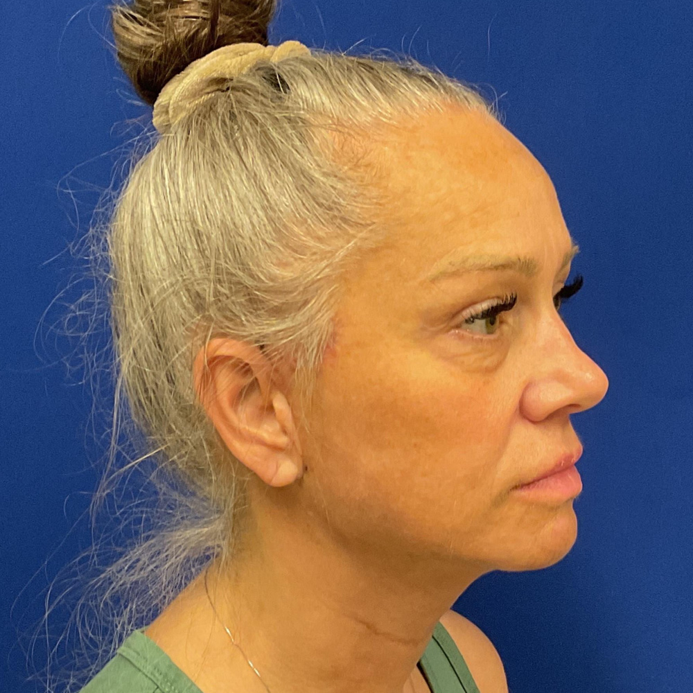 Facelift and necklift after the surgery