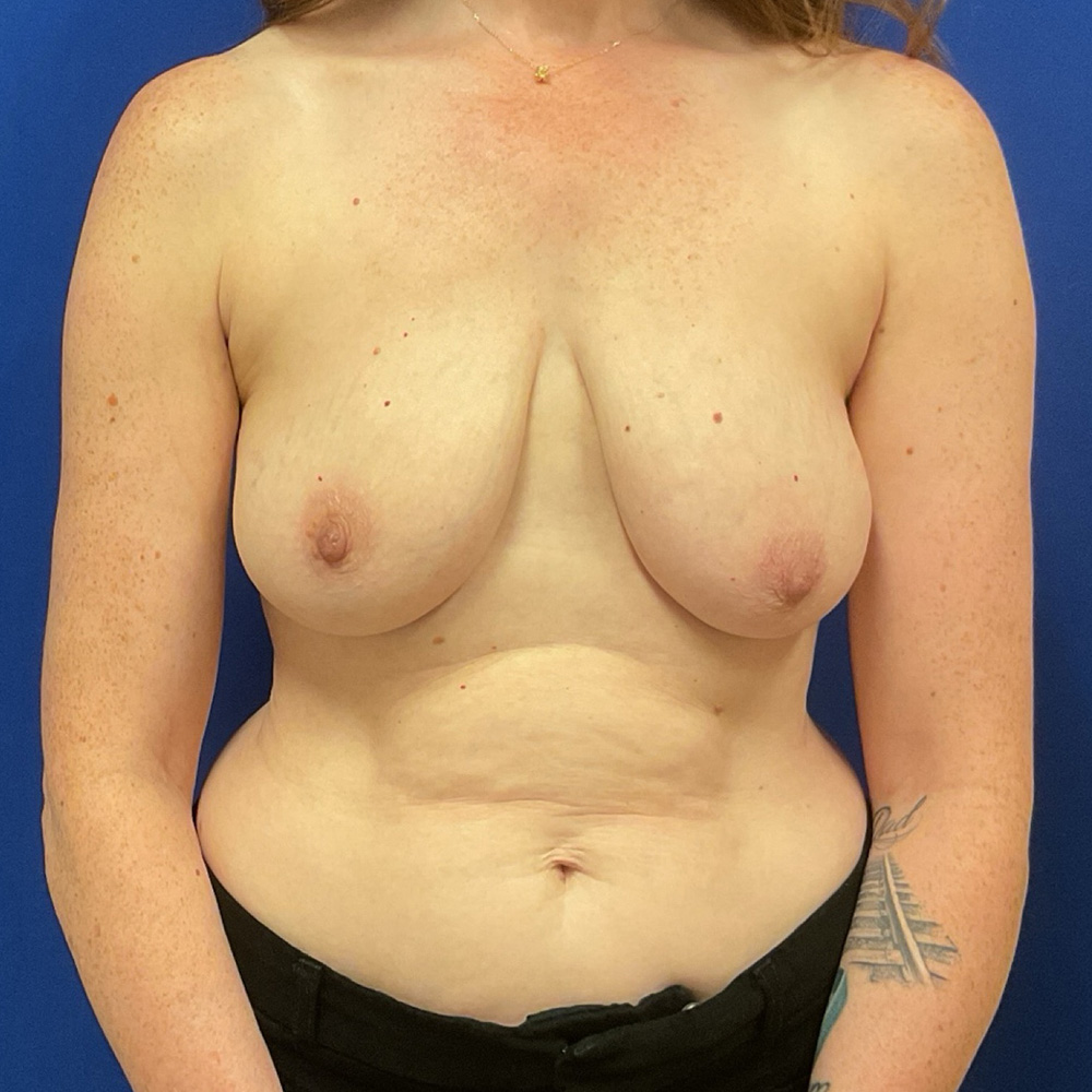 Before mommy makeover procedure with dr. iyengar