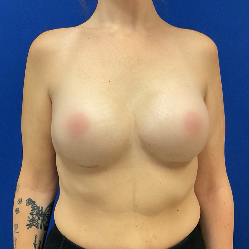 after breast augmentation procedure with dr raj iyengar