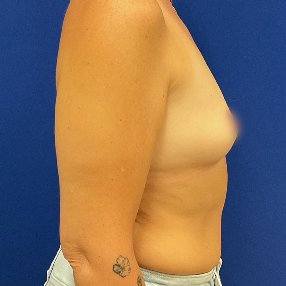 before breast augmentation procedure with dr raj iyengar