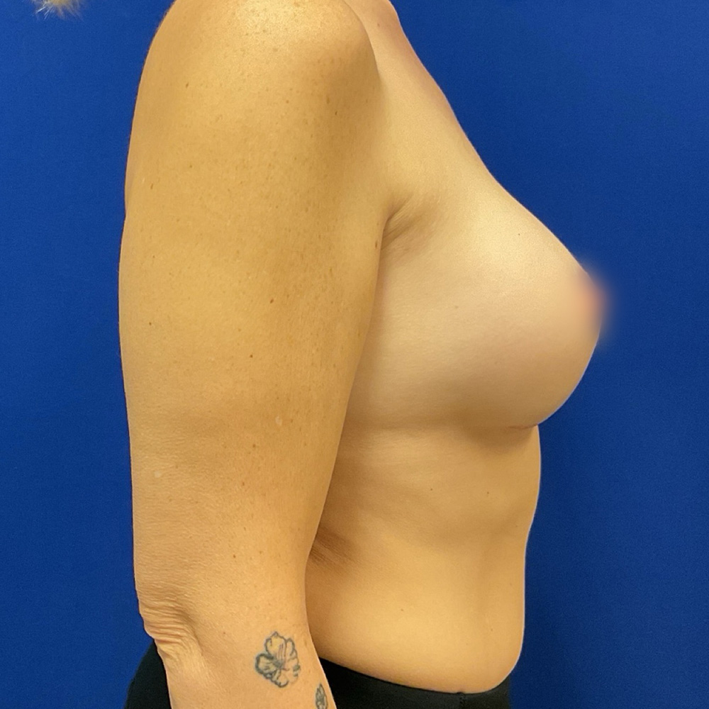 after breast augmentation procedure with dr raj iyengar