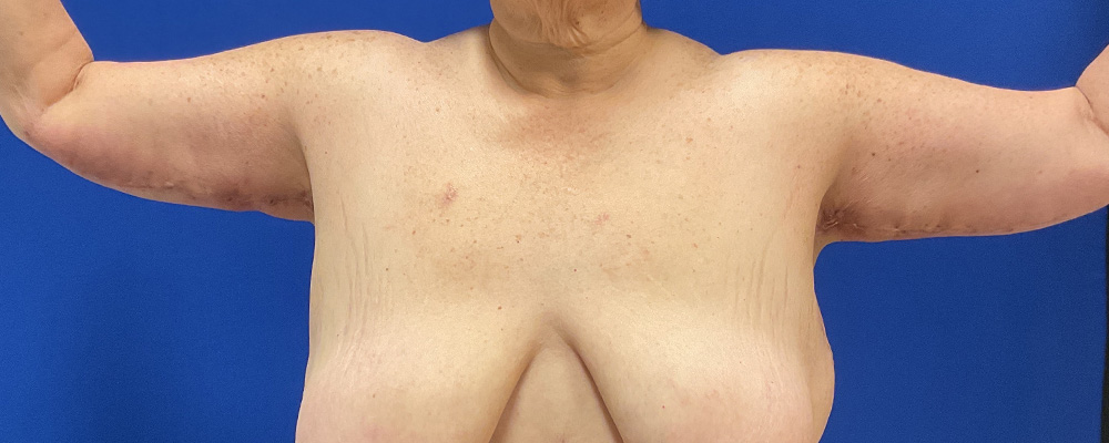 arm lift with dr raj iyengar - after