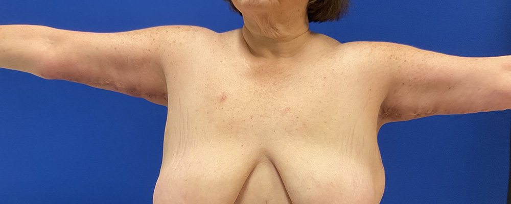 arm lift with dr raj iyengar - after