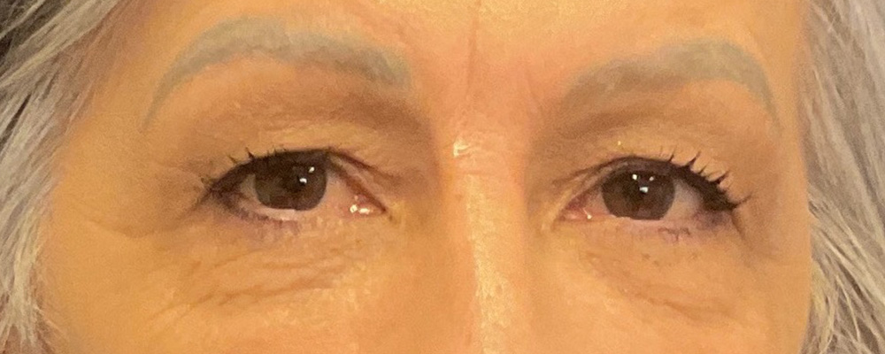 Bilateral Upper Bleph, Brow Lift with dr raj iyengar - before
