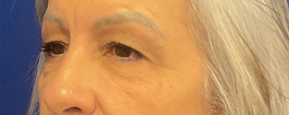Bilateral Upper Bleph, Brow Lift with dr raj iyengar - before