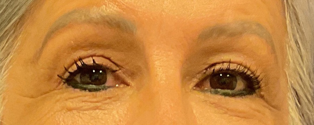 Bilateral Upper Bleph, Brow Lift with dr raj iyengar - after