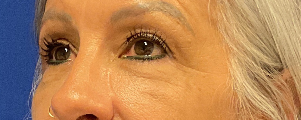 Bilateral Upper Bleph, Brow Lift with dr raj iyengar - after