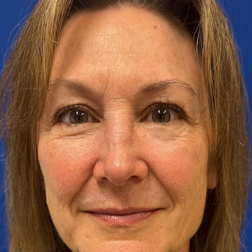 Bilateral Upper Bleph and Facial Fat Grafting with dr raj iyengar - before