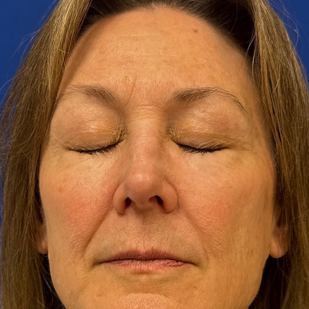 Bilateral Upper Bleph and Facial Fat Grafting with dr raj iyengar - before
