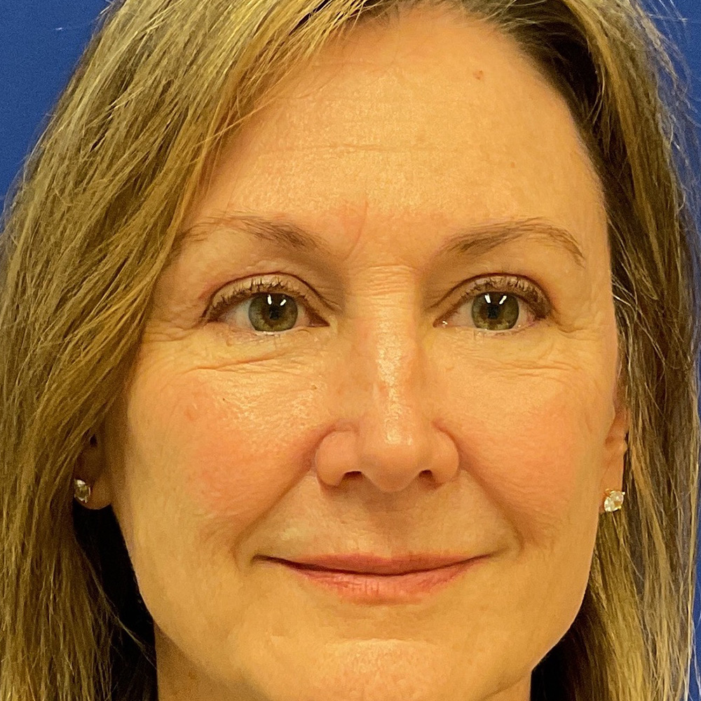 Bilateral Upper Bleph and Facial Fat Grafting with dr raj iyengar - after