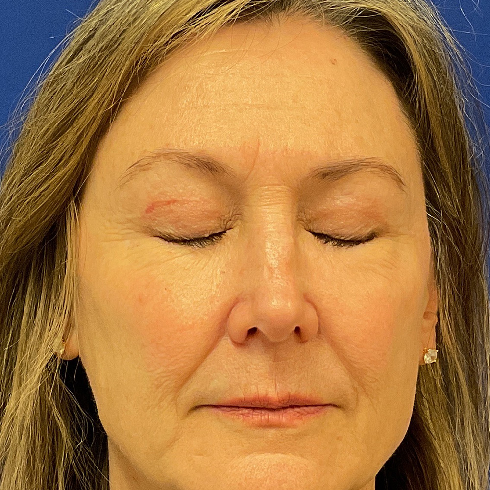 Bilateral Upper Bleph and Facial Fat Grafting with dr raj iyengar - after