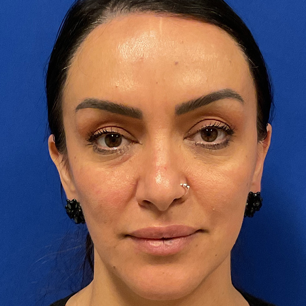Facial Filler with dr raj iyengar - before