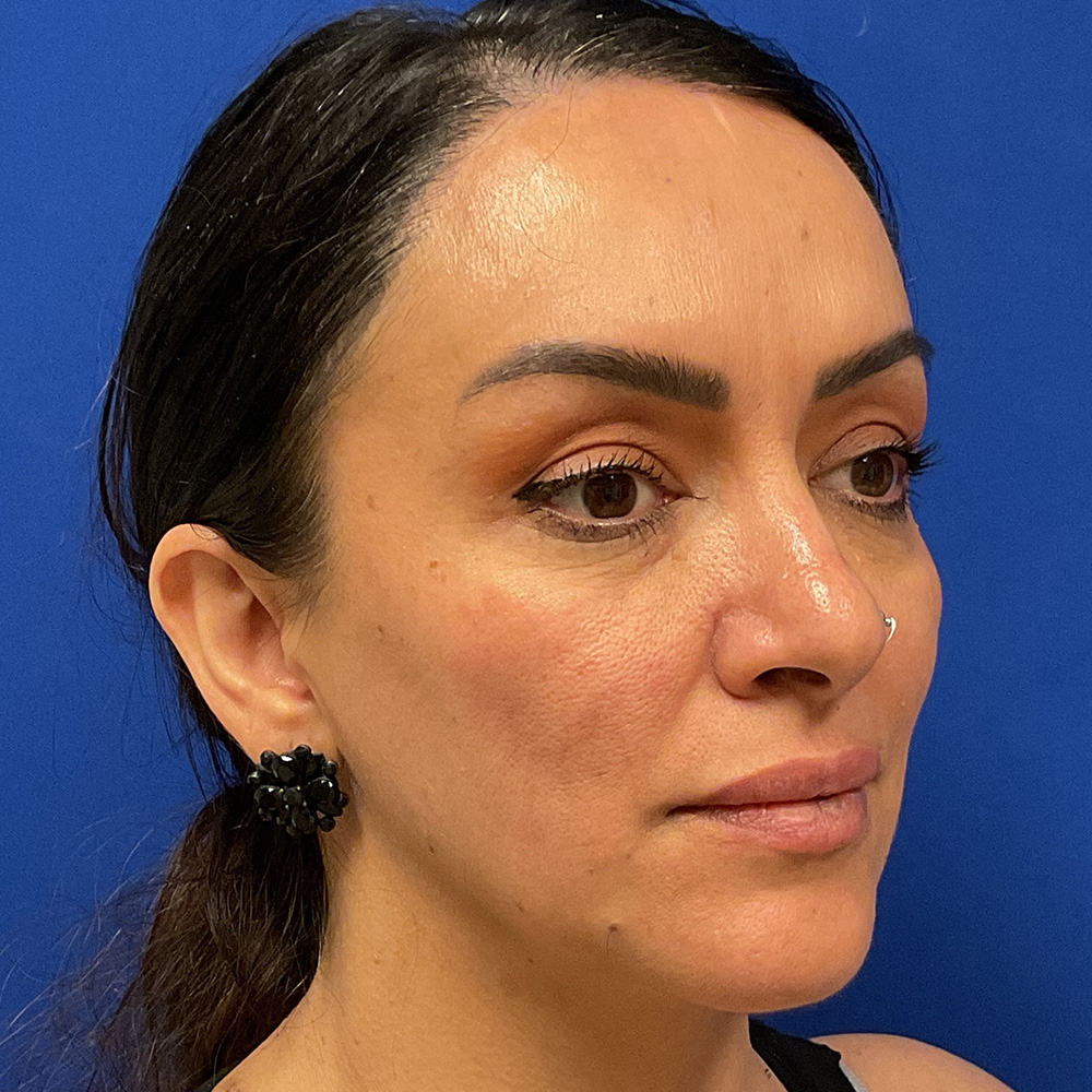 Facial Filler with dr raj iyengar - before