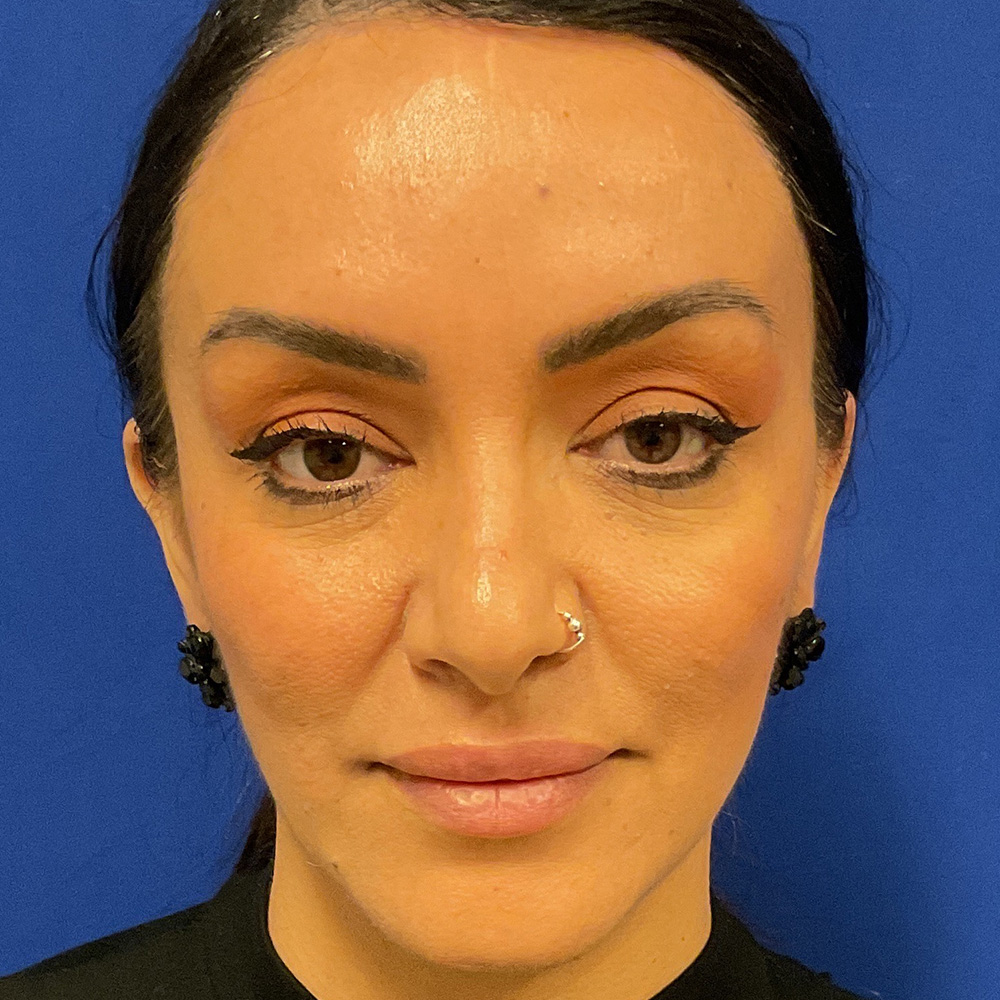 Facial Filler with dr raj iyengar - after