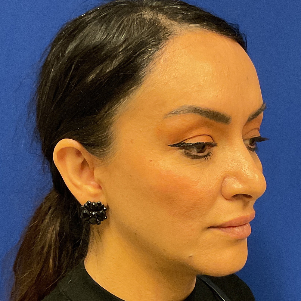 Facial Filler with dr raj iyengar - after
