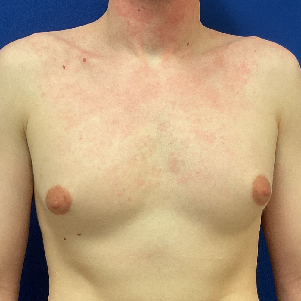 Gynecomastia with dr raj iyengar - before