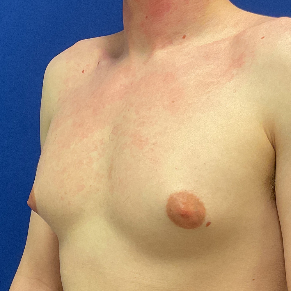 Gynecomastia with dr raj iyengar - before