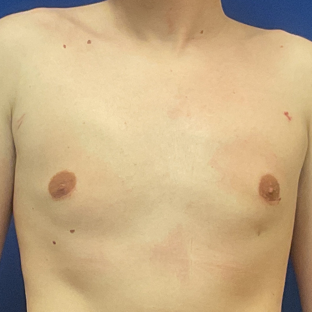 Gynecomastia with dr raj iyengar - after