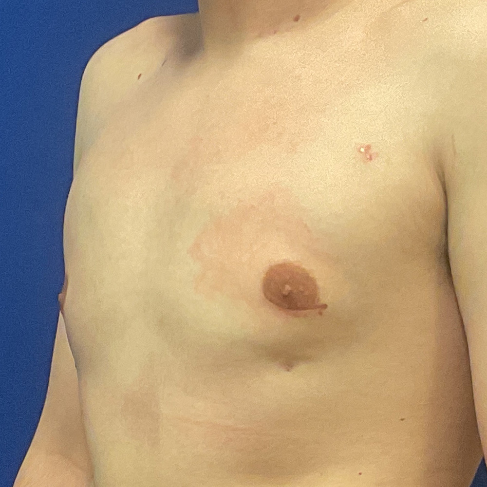 Gynecomastia with dr raj iyengar - after