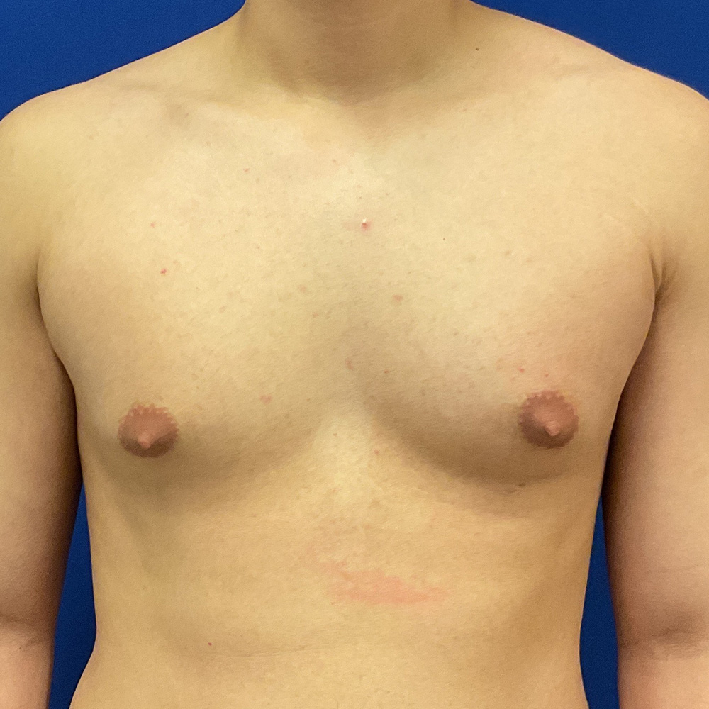 Gynecomastia with dr raj iyengar - before