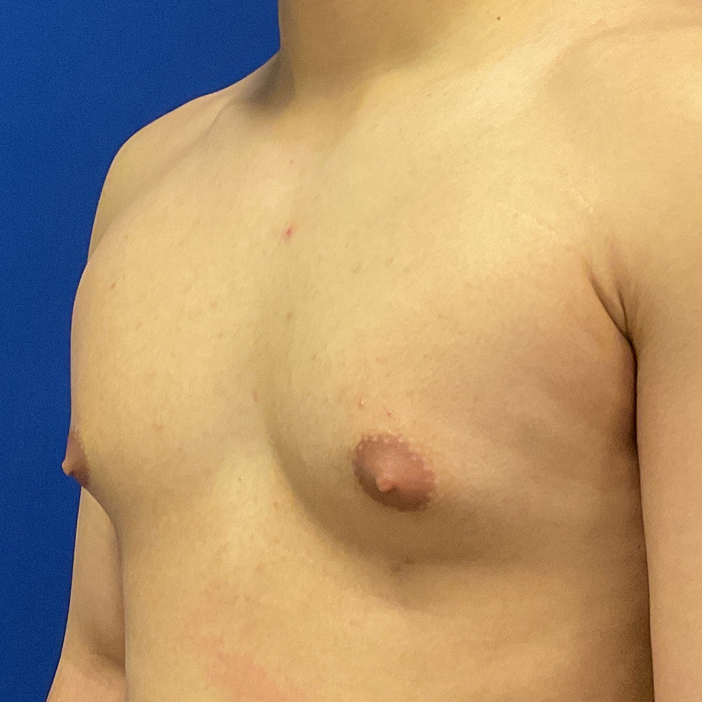 Gynecomastia with dr raj iyengar - before