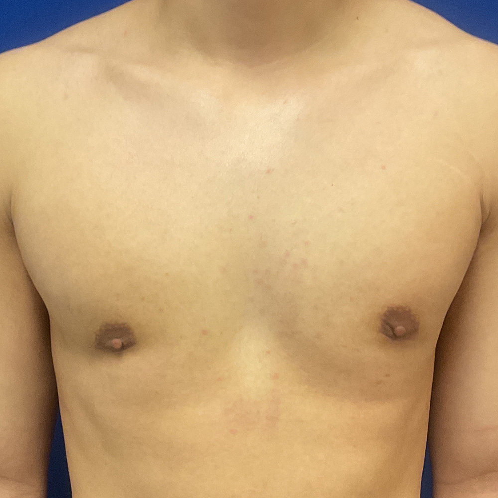 Gynecomastia with dr raj iyengar - after