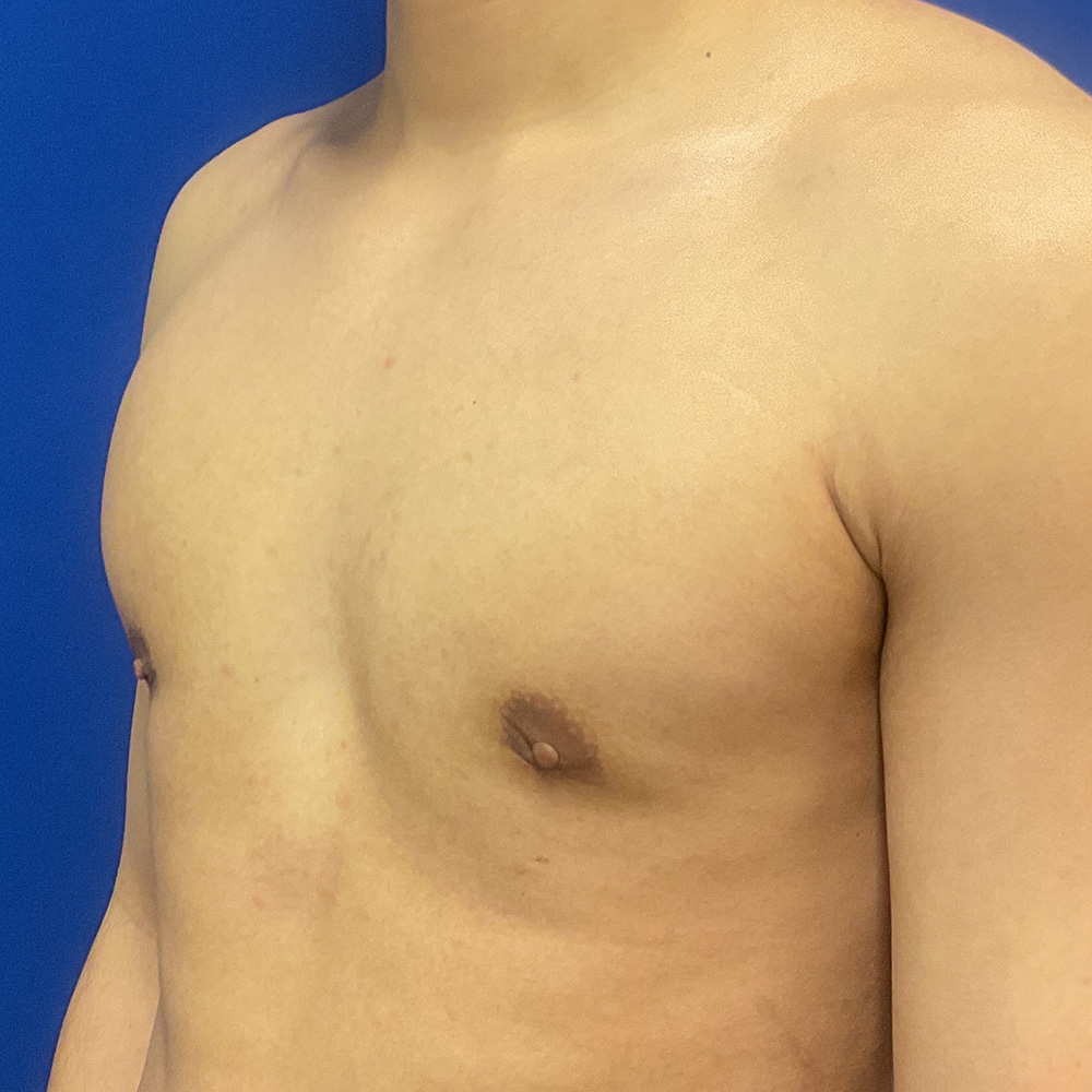 Gynecomastia with dr raj iyengar - after