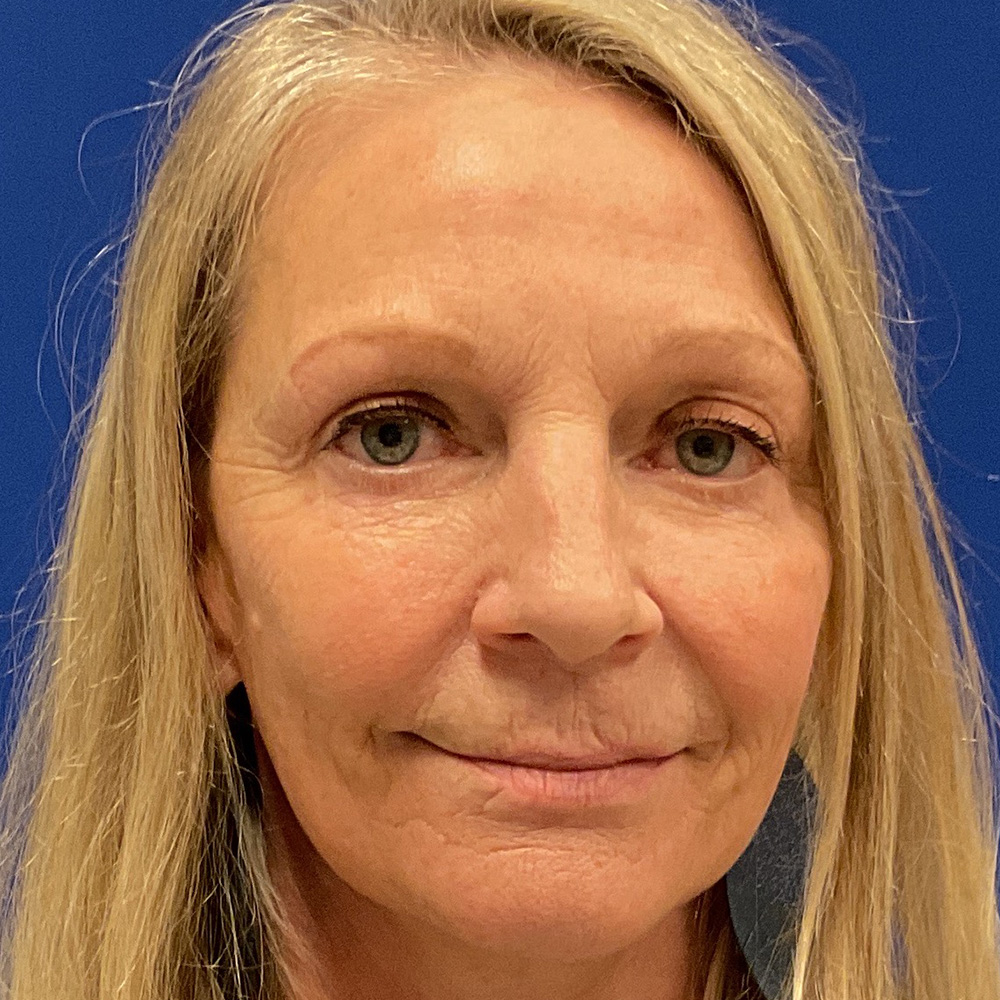 Lip Lift with dr raj iyengar - before