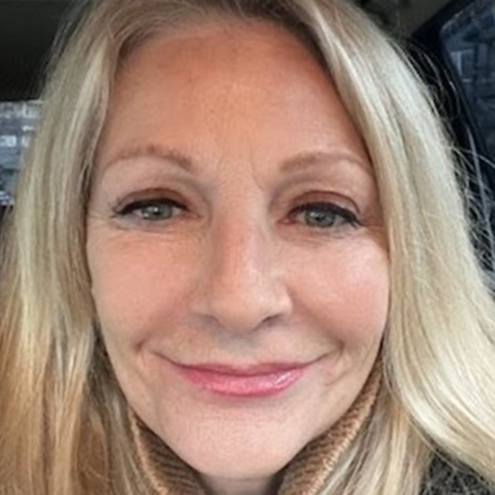 Lip Lift with dr raj iyengar - after