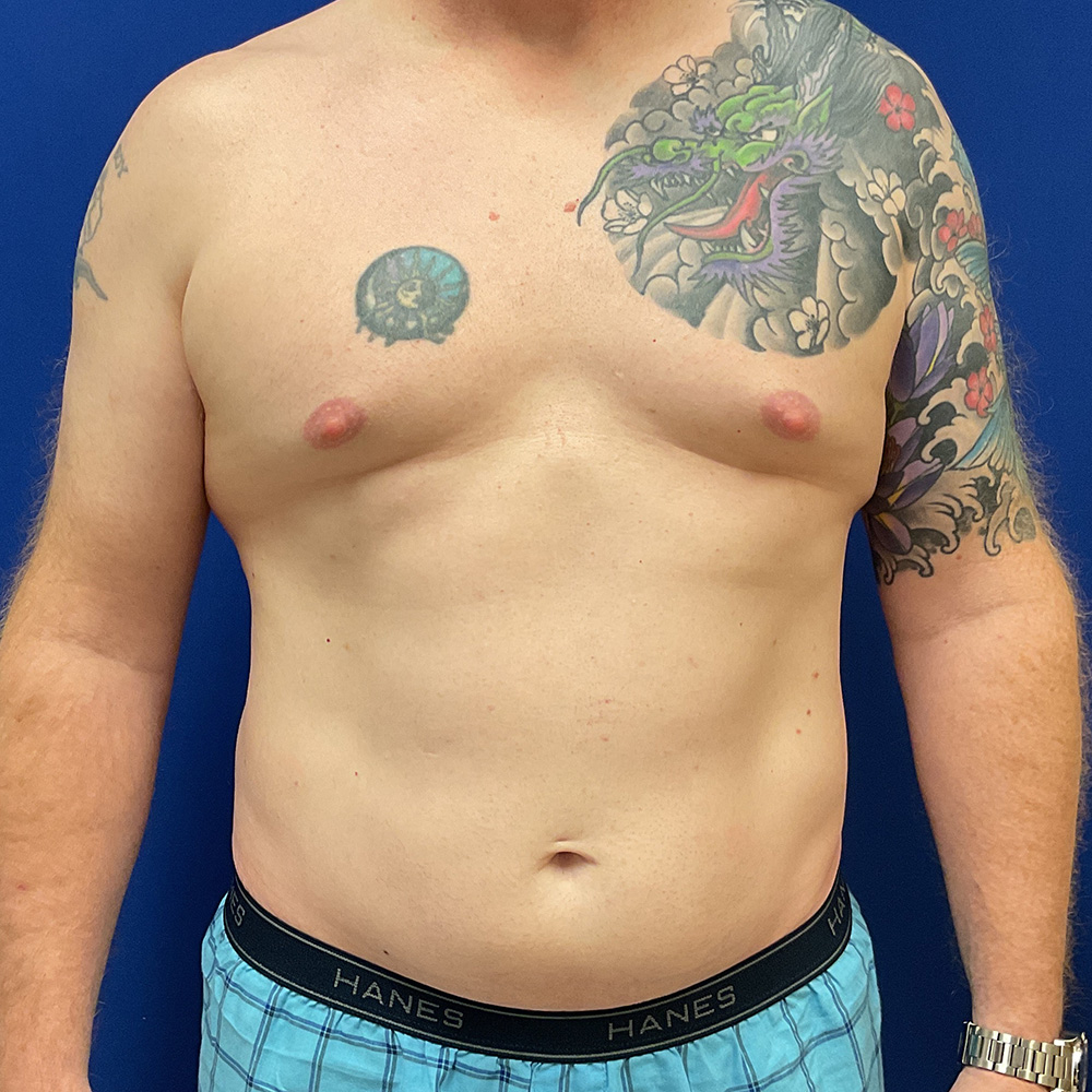 Liposuction with Renuvion with dr raj iyengar - before