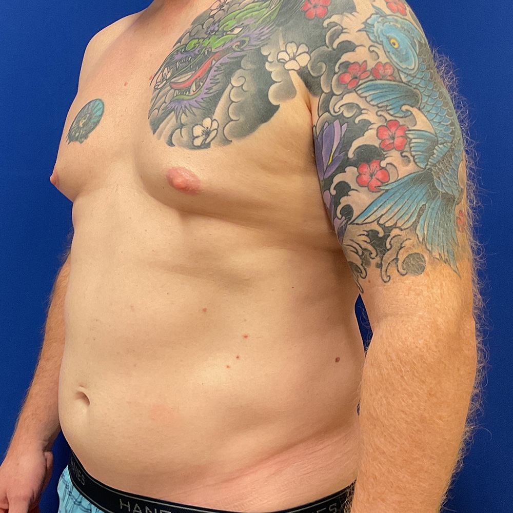 Liposuction with Renuvion with dr raj iyengar - before