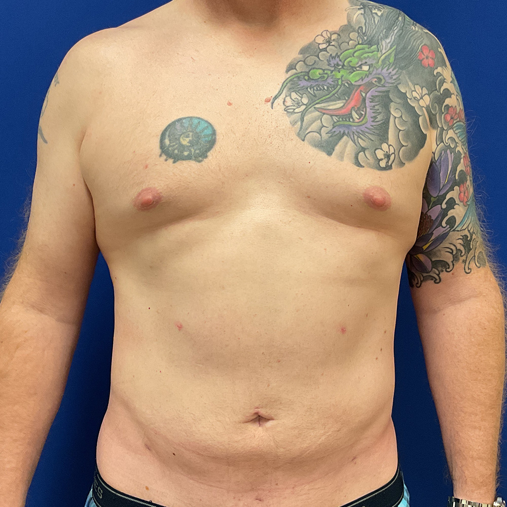 Liposuction with Renuvion with dr raj iyengar - after