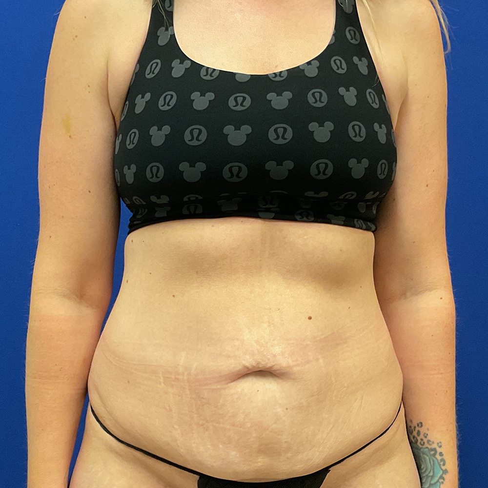 Tummy Tuck with dr raj iyengar - before