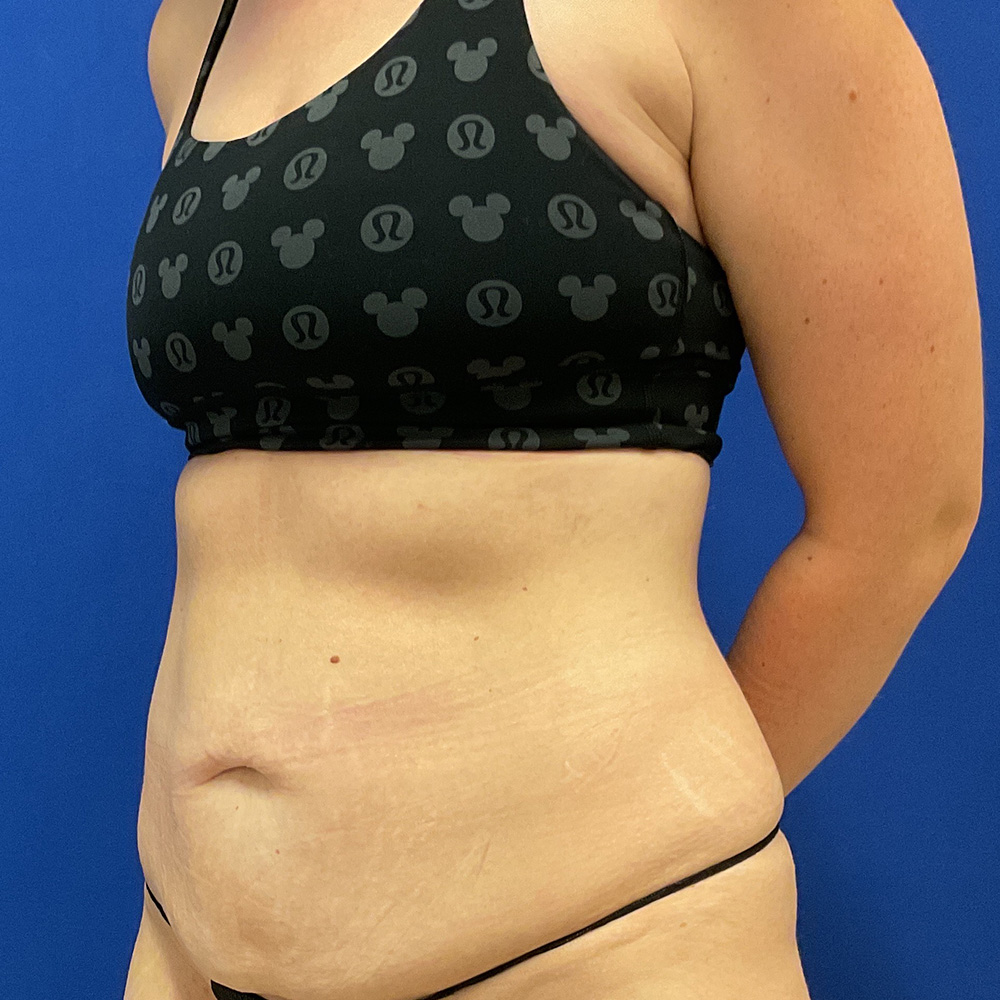 Tummy Tuck with dr raj iyengar - before